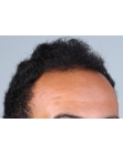 Before Hair Transplant&nbsp;Front